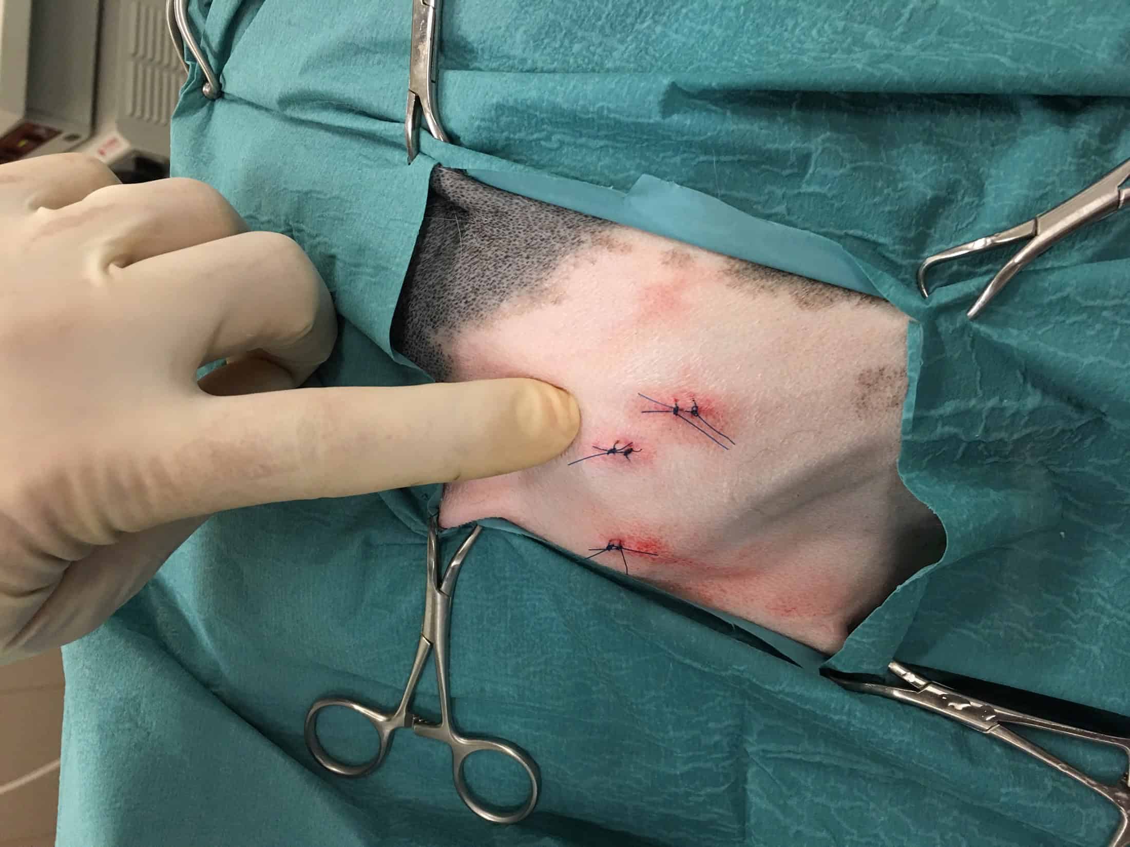 Arthroscopy skin sutures, small incisions, minimally invasive