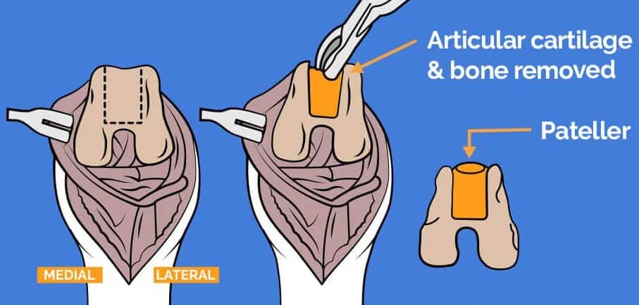 MPL Surgery Concept Diagram