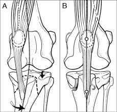 MPL Surgery Osteotomy 1