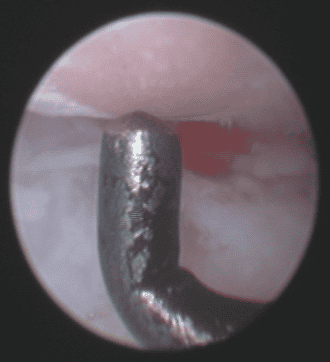 athroscopy arthritis