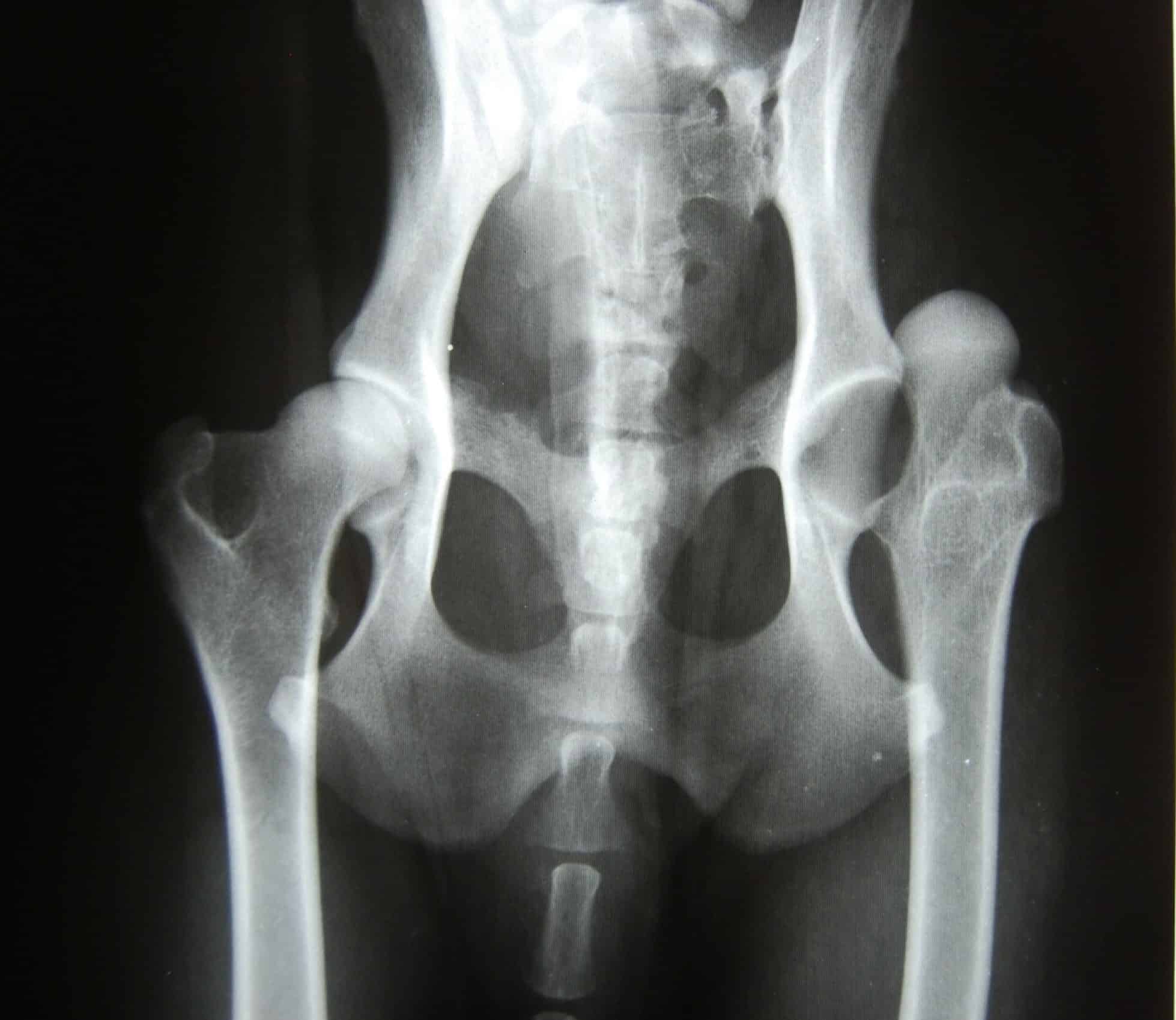 hip dislocation