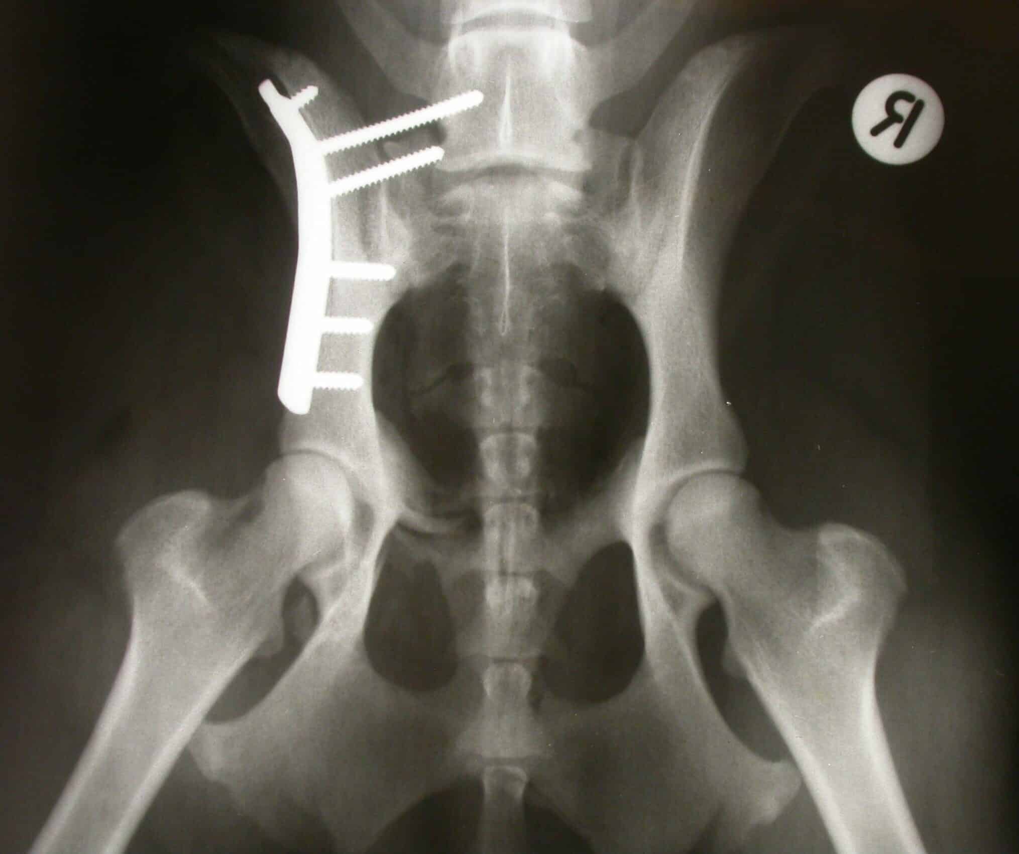 pelvic fracture postop, after the plate and screws have been put in