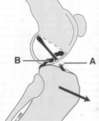 torn ACL