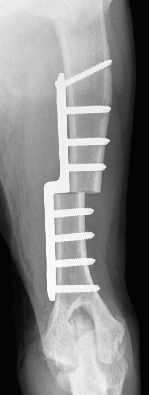 X-ray with bone plate osteotomy