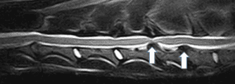 MRI spine