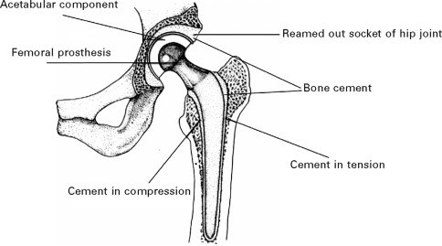 cemented hip replacement