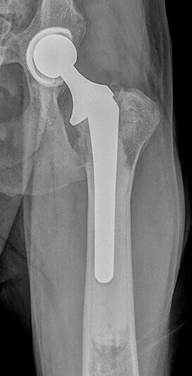 cemented total hip replacement