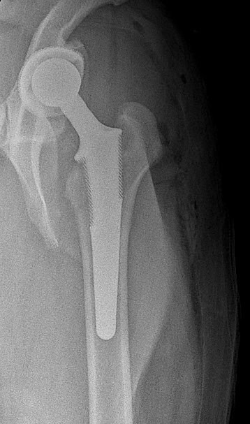 cementless hip replacement THR