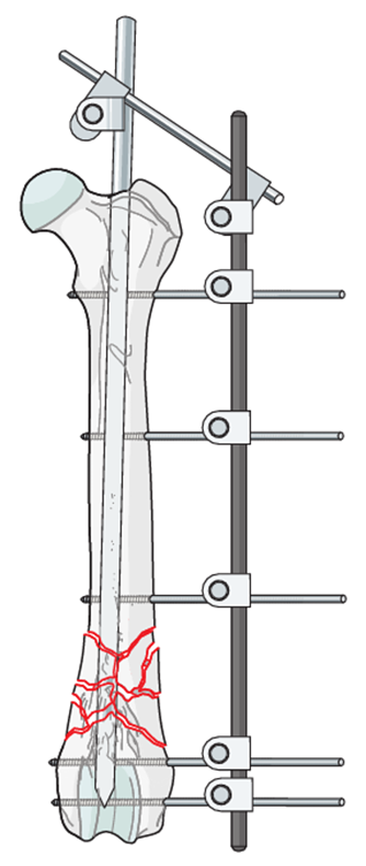 external fixation