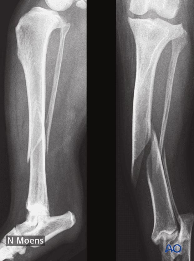 oblique fracture