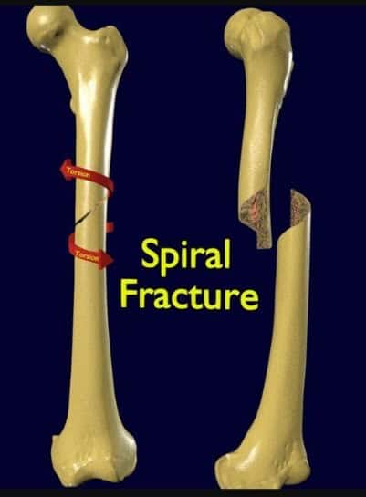 spiral fracture