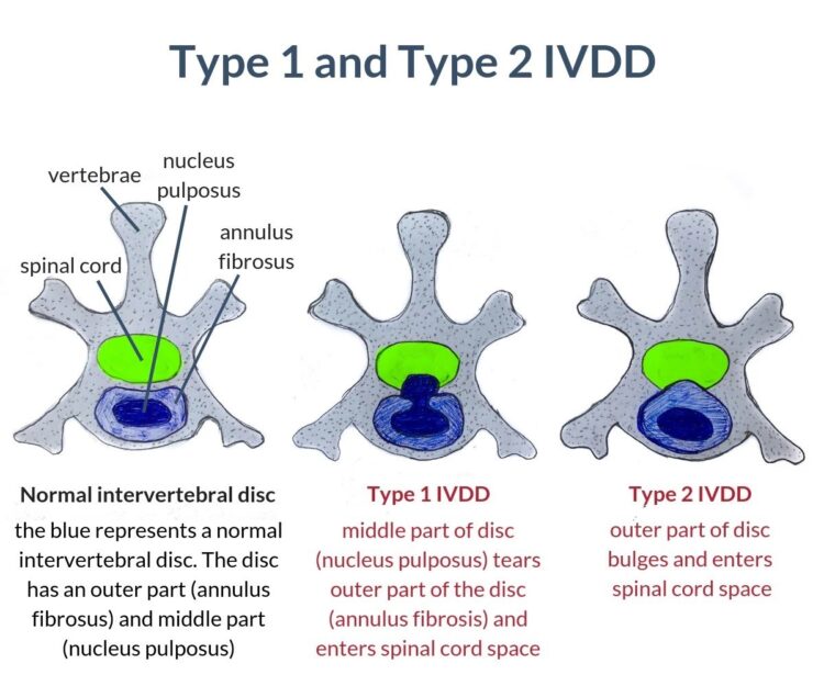 type 1 and type 2 ivdd