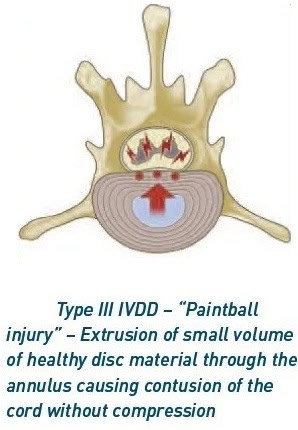 types of IVDD 1