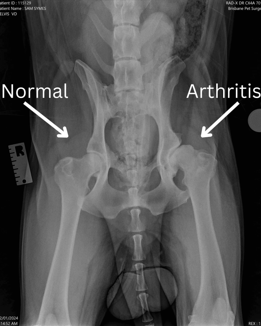 Hip OA unilateral with labels, the left hip is normal, however the right hip has arthritis